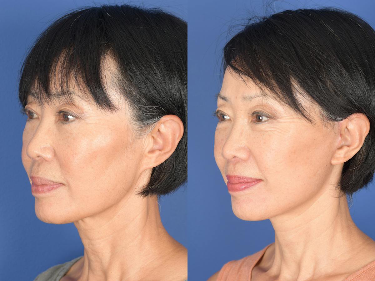 Facelift Before & After Gallery - Patient 198653 - Image 4