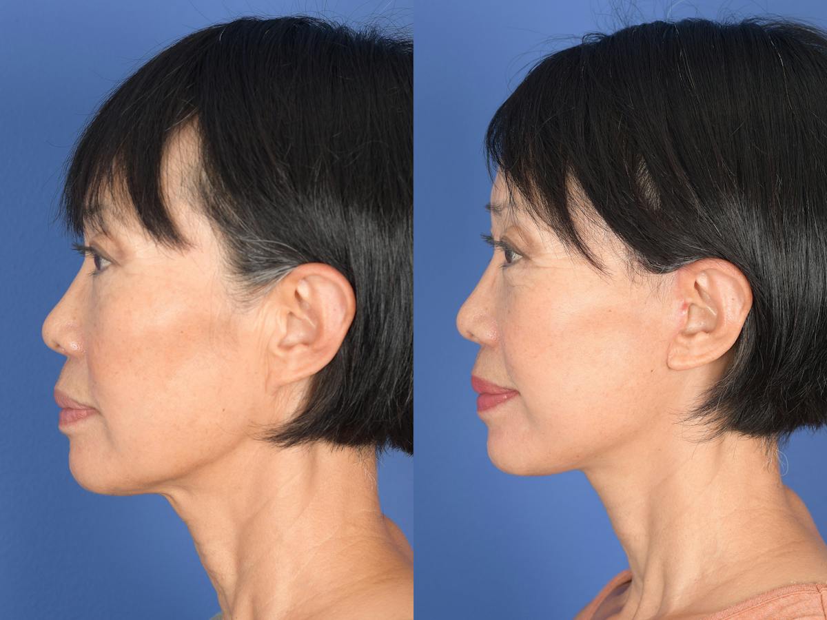 Facelift Before & After Gallery - Patient 198653 - Image 5