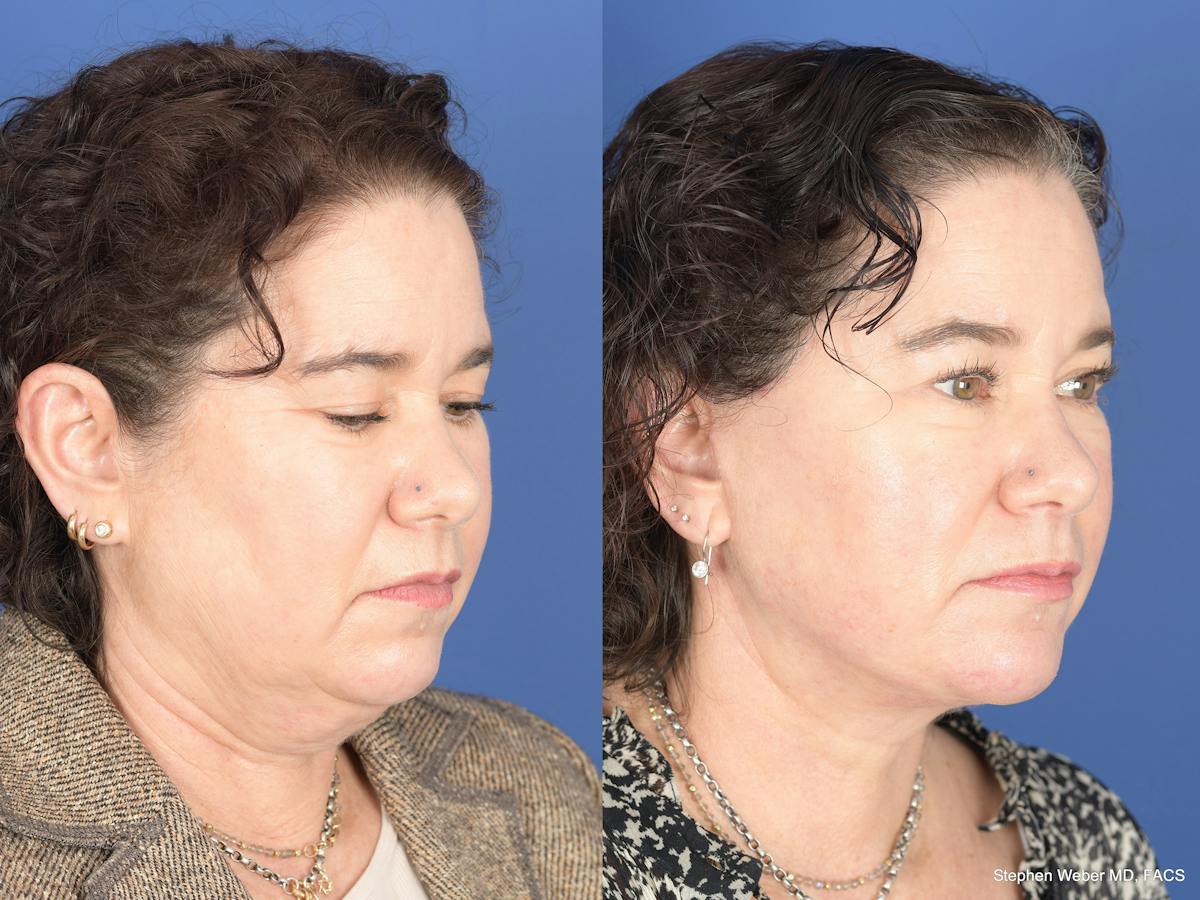 Facelift Before & After Gallery - Patient 879206 - Image 2
