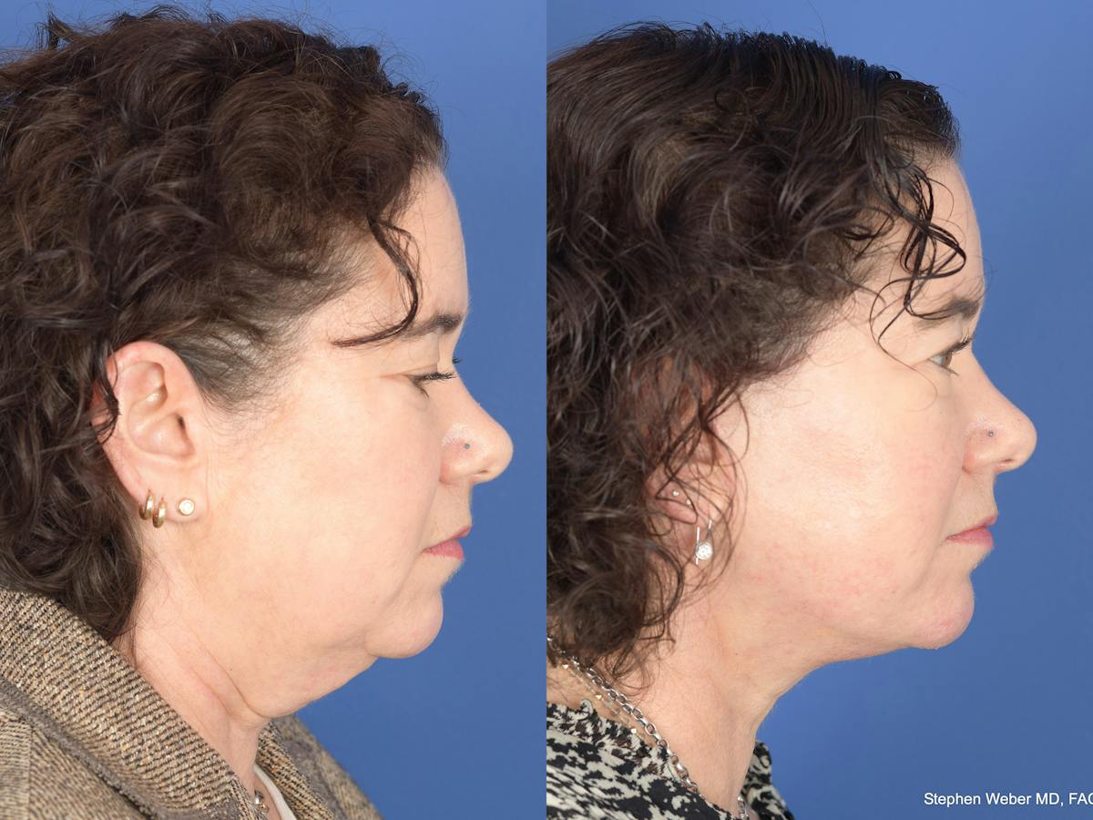 Facelift Before & After Gallery - Patient 879206 - Image 3
