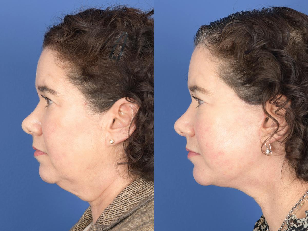 Facelift Before & After Gallery - Patient 879206 - Image 5