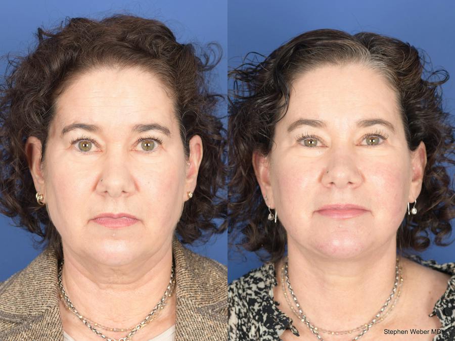 Why Our Photo Gallery Is Better Before and After Photos