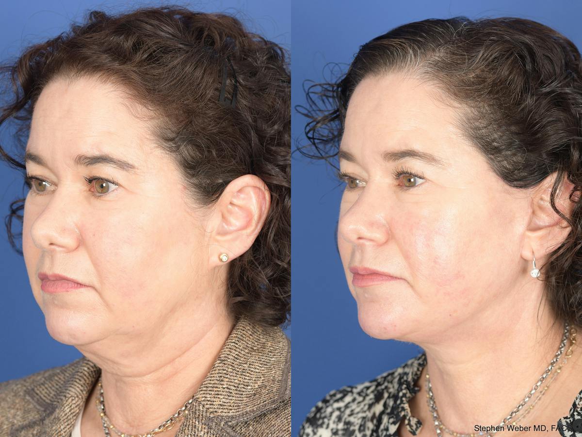 Facelift Before & After Gallery - Patient 879206 - Image 4