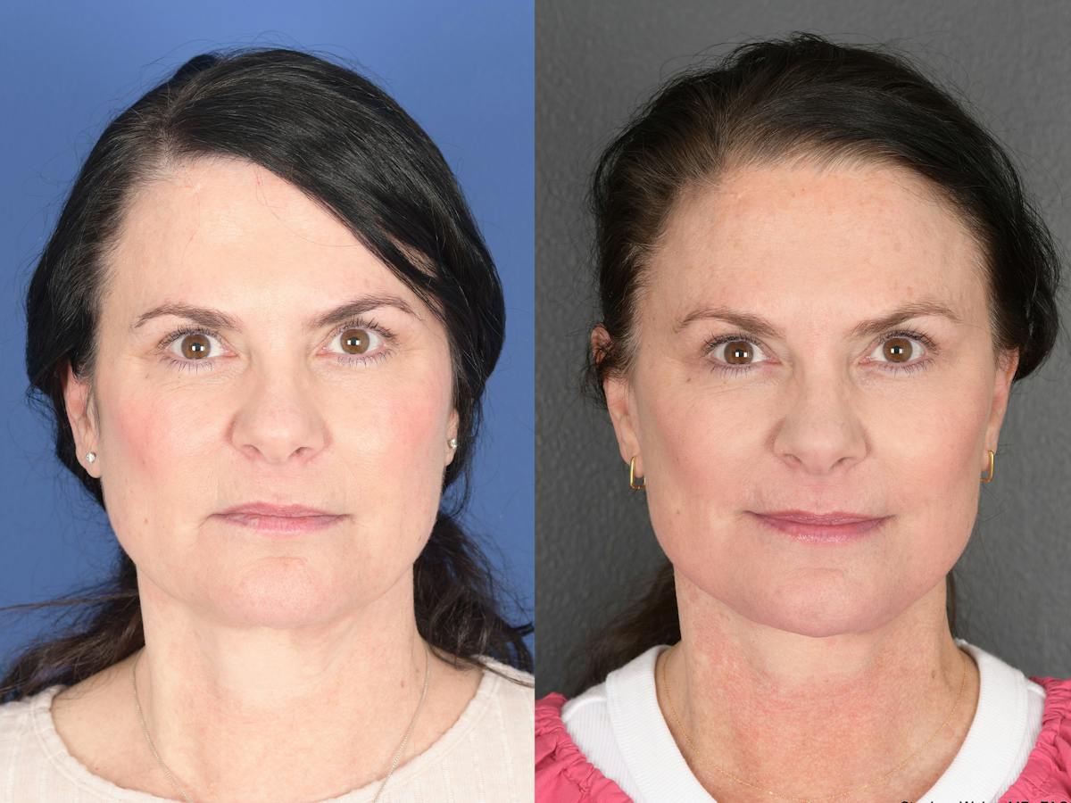 Facelift Before & After Gallery - Patient 247280 - Image 1