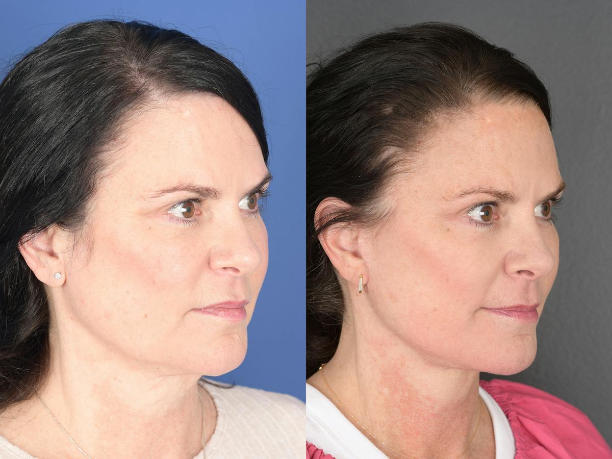 Facelift Before & After Gallery - Patient 247280 - Image 2