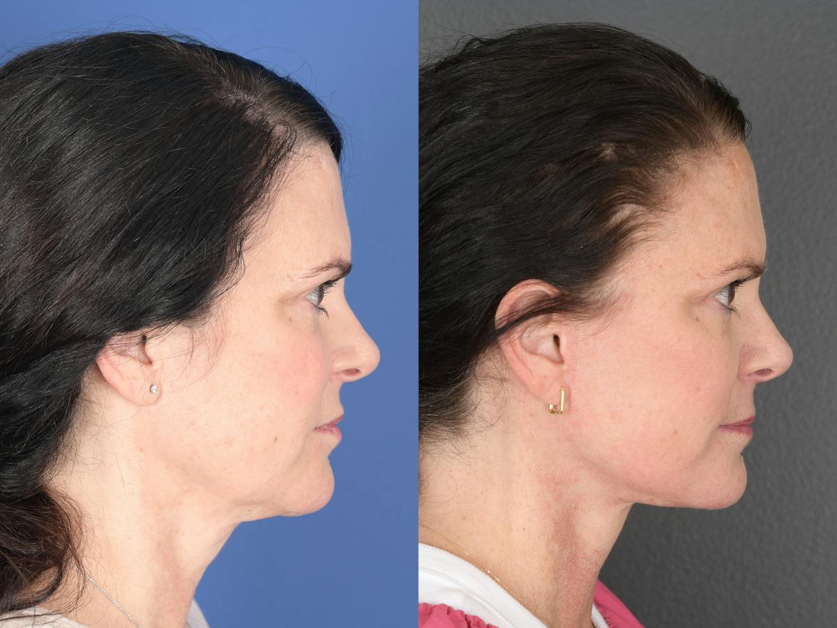 Facelift Before & After Gallery - Patient 247280 - Image 3