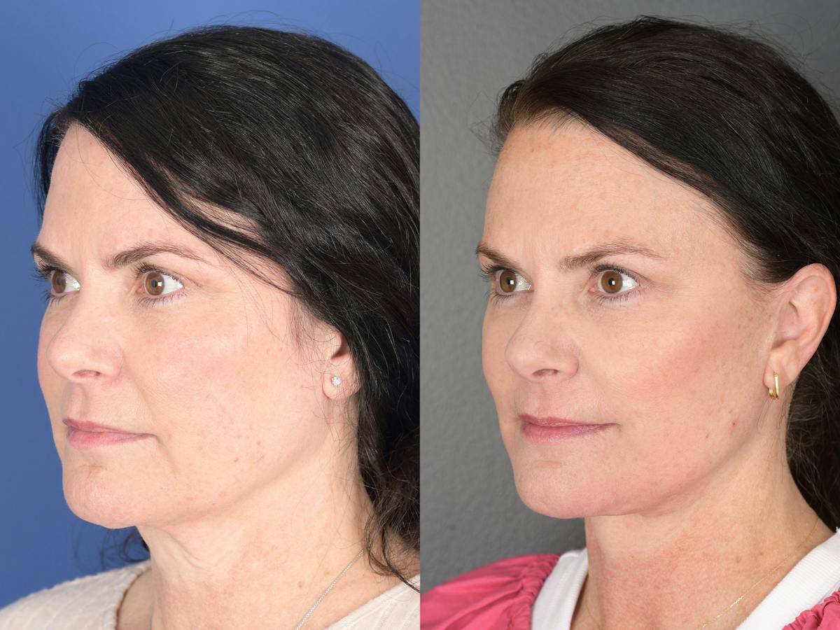 Facelift Before & After Gallery - Patient 247280 - Image 4