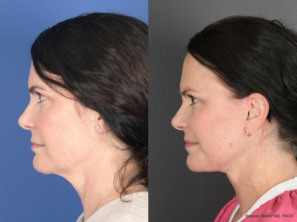 Facelift Before & After Gallery - Patient 247280 - Image 5