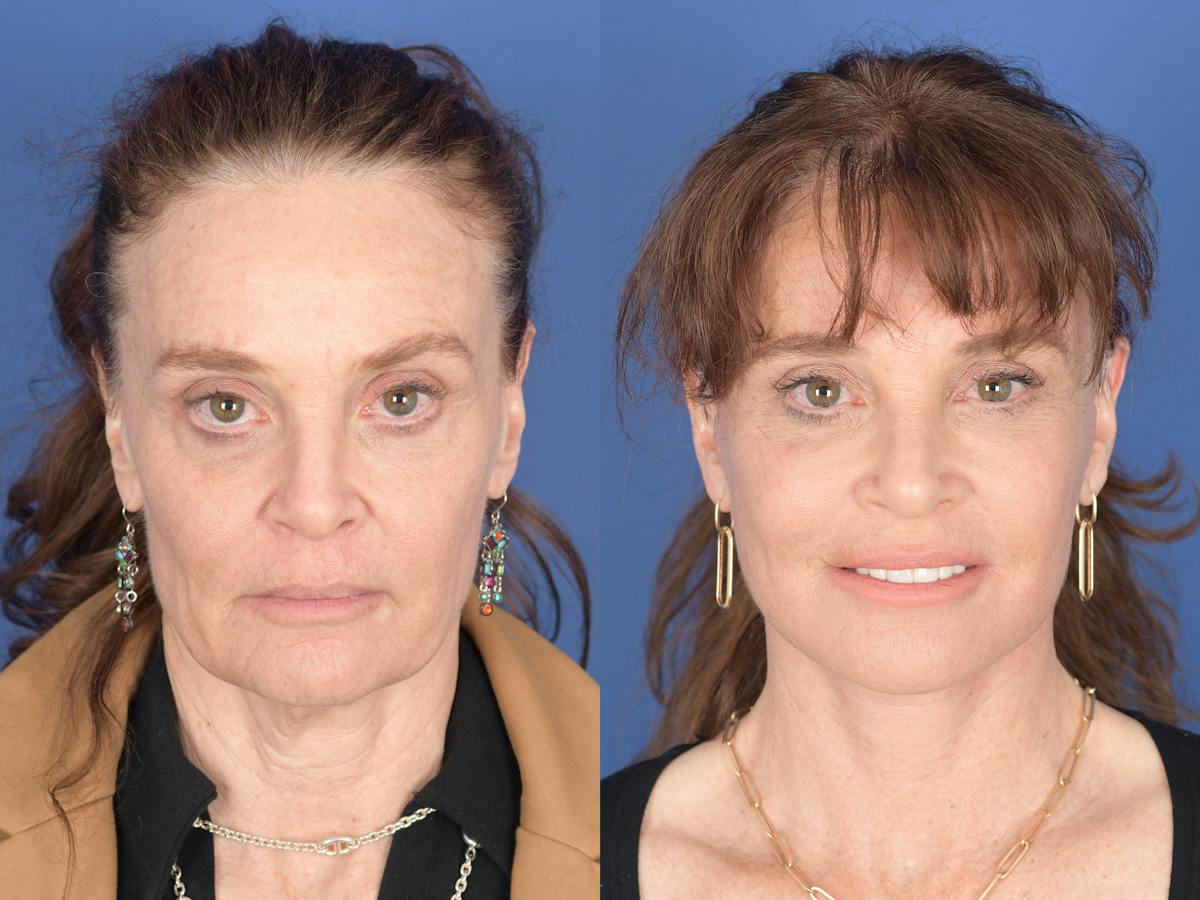 Facelift Before & After Gallery - Patient 247785 - Image 1
