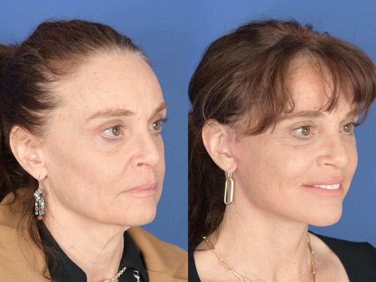 Facelift Before & After Gallery - Patient 247785 - Image 2