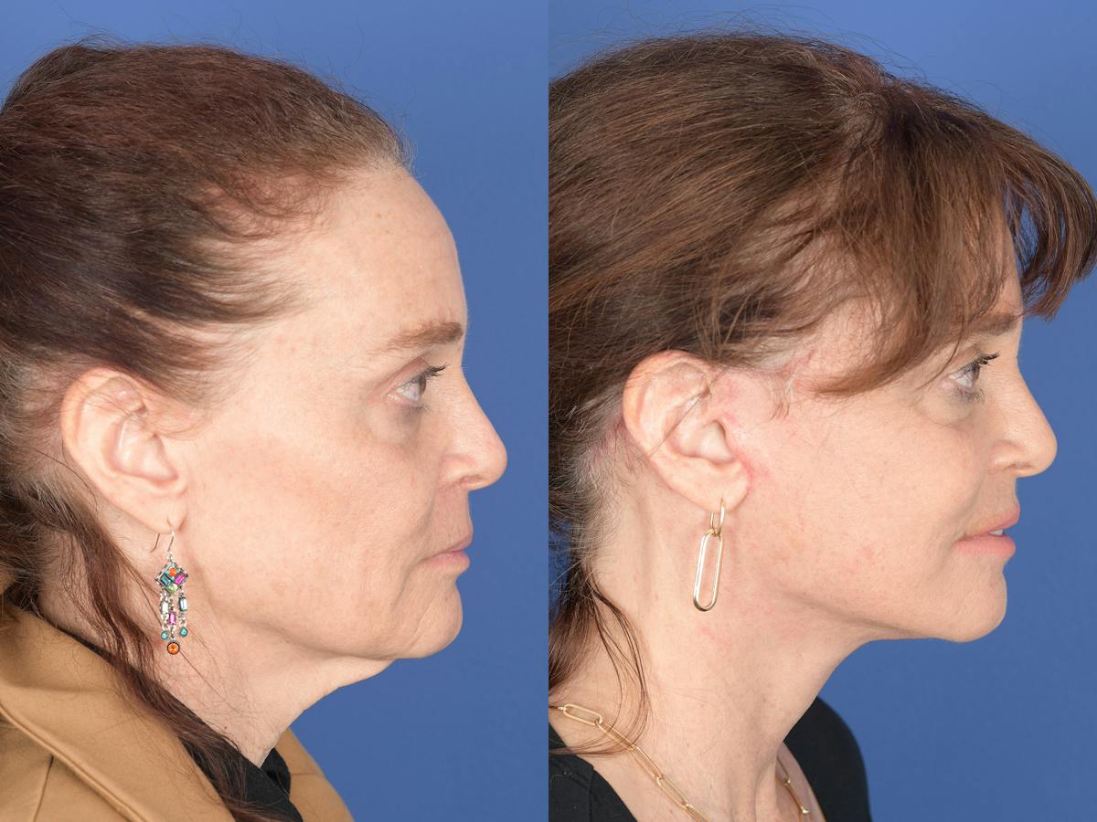 Facelift Before & After Gallery - Patient 247785 - Image 3