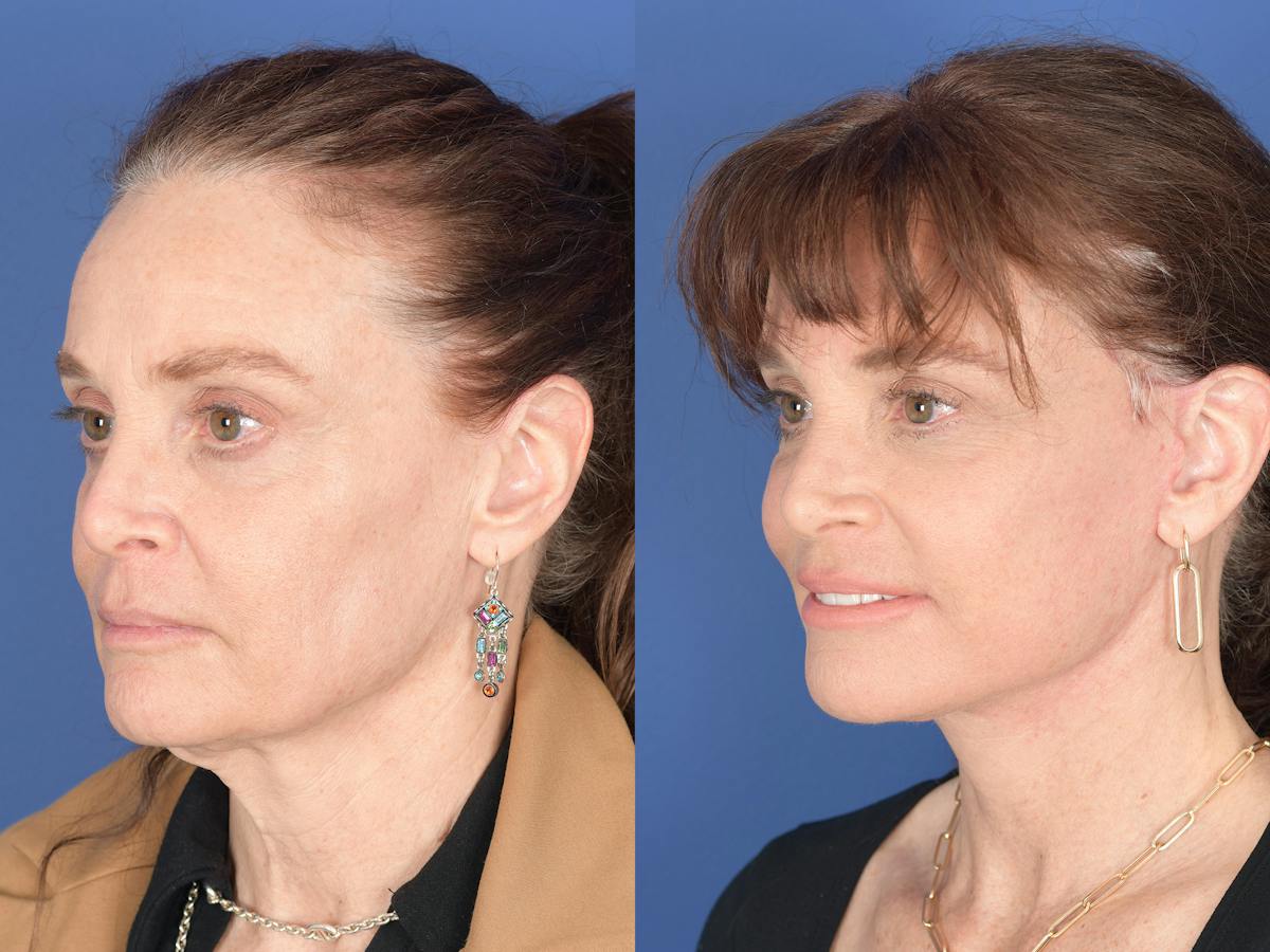 Facelift Before & After Gallery - Patient 247785 - Image 4