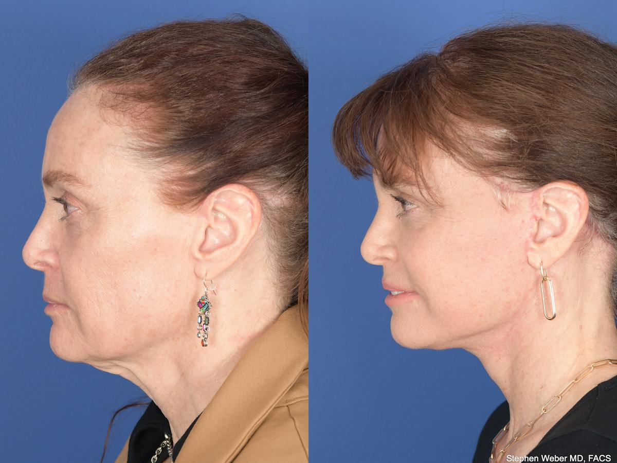 Facelift Before & After Gallery - Patient 247785 - Image 5