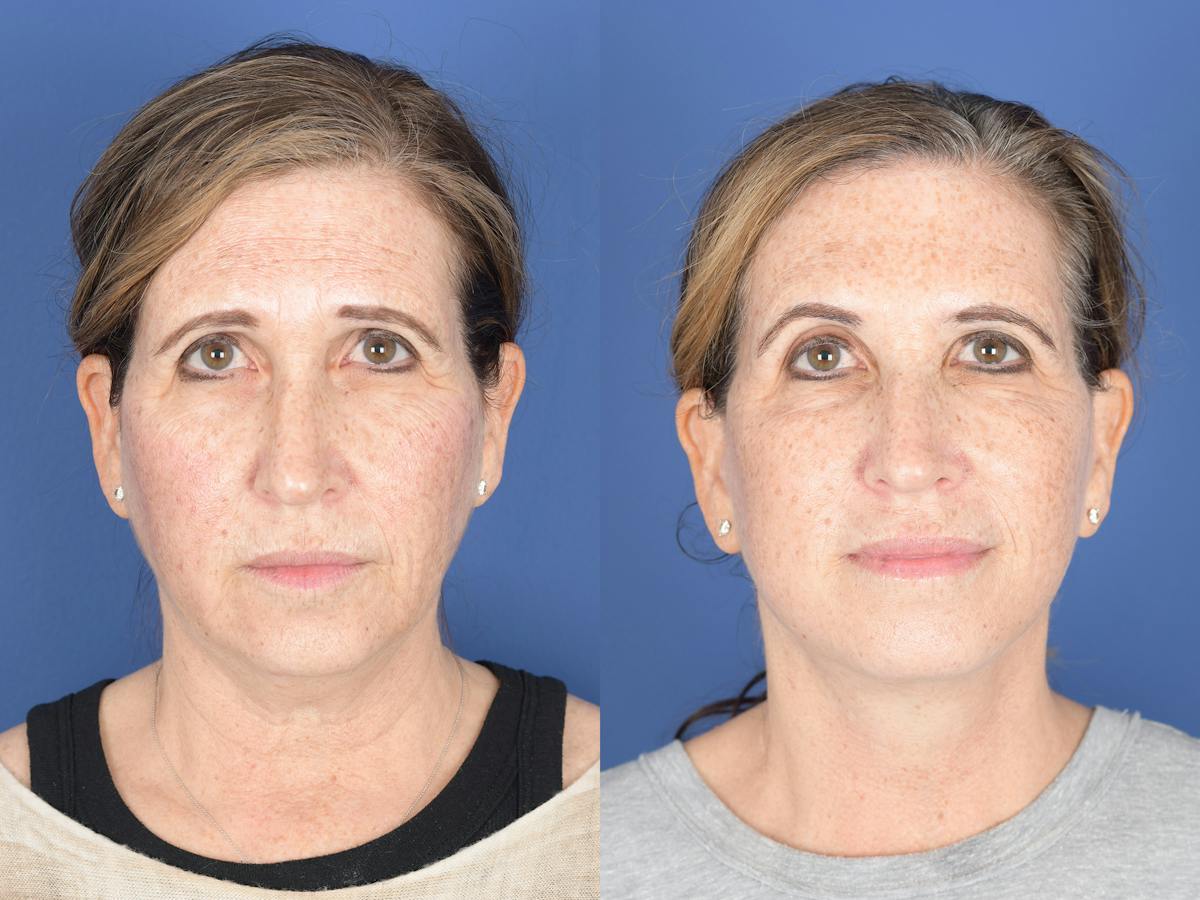 Facelift Before & After Gallery - Patient 406156 - Image 1