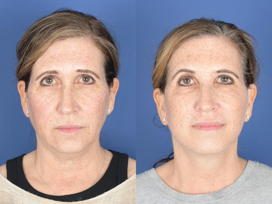 Why Our Photo Gallery Is Better Before and After Photos