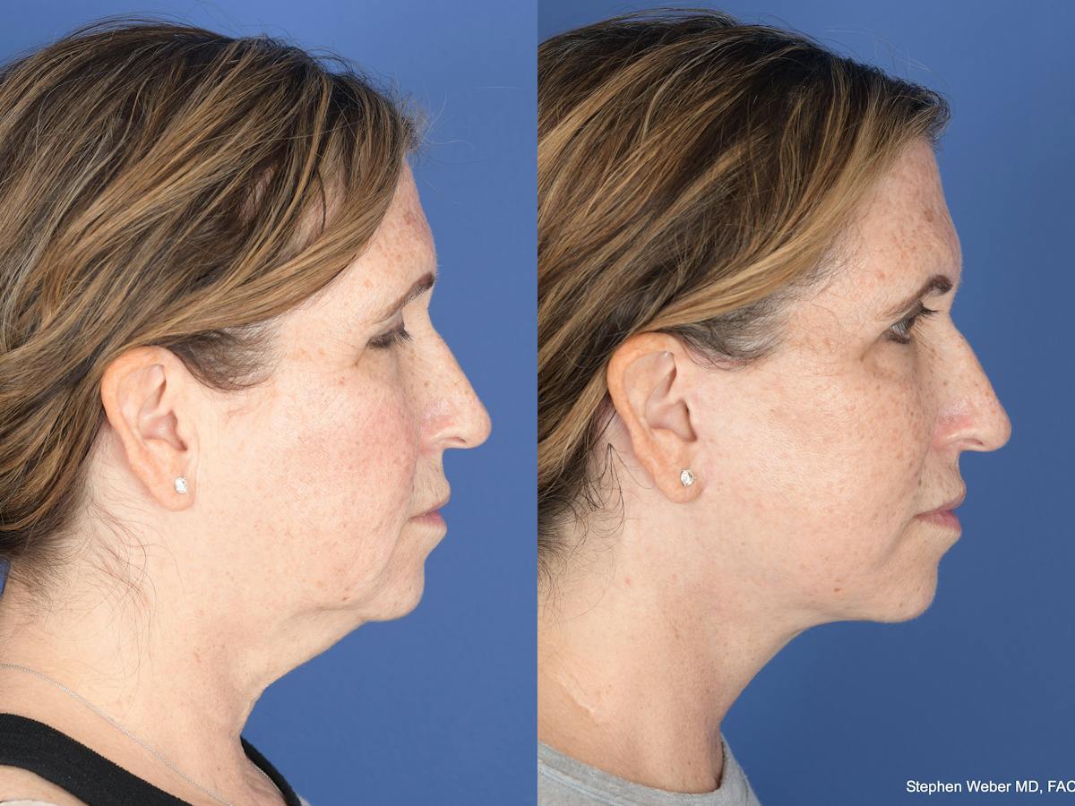 Facelift Before & After Gallery - Patient 406156 - Image 3
