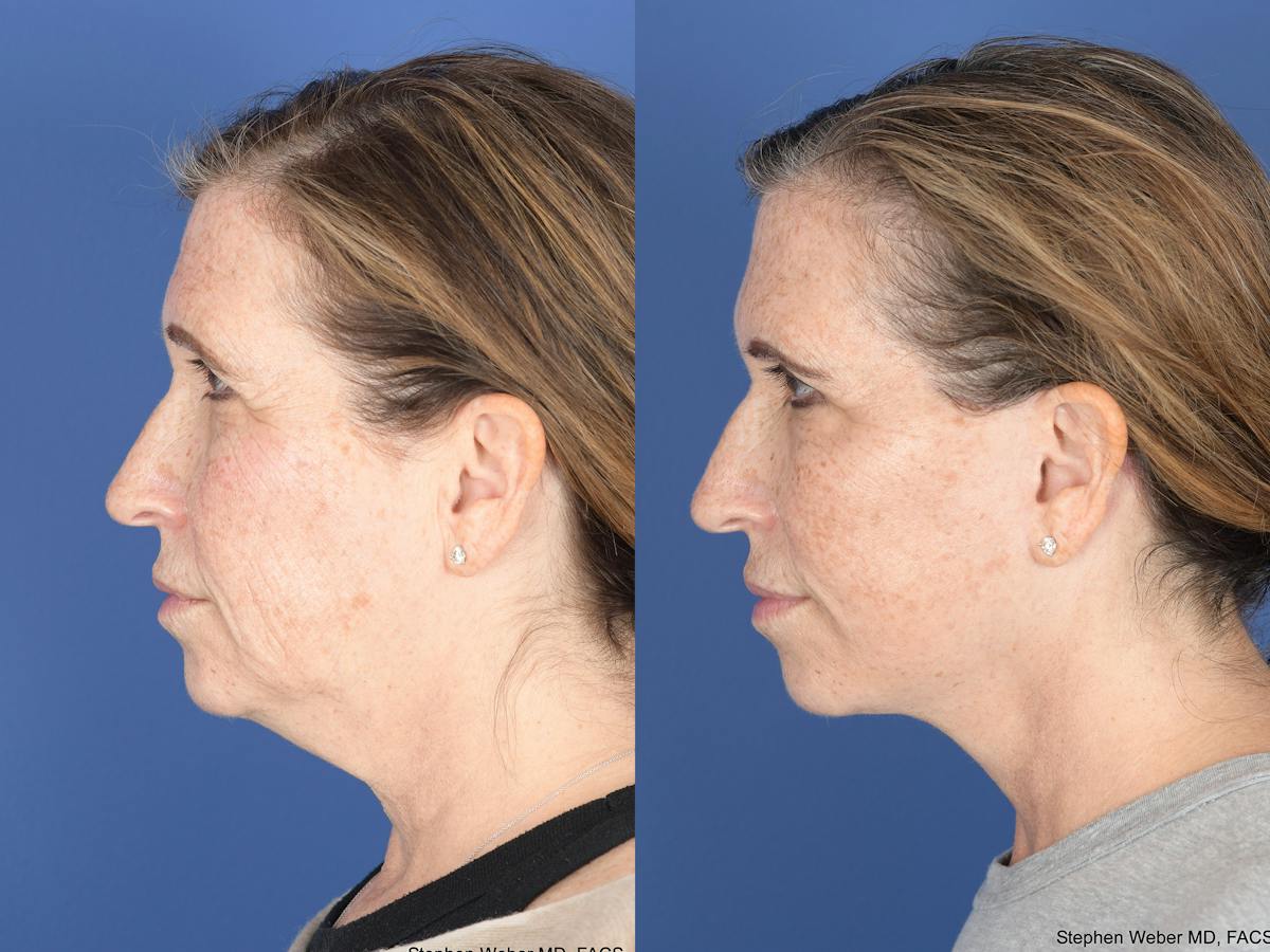 Facelift Before & After Gallery - Patient 406156 - Image 5