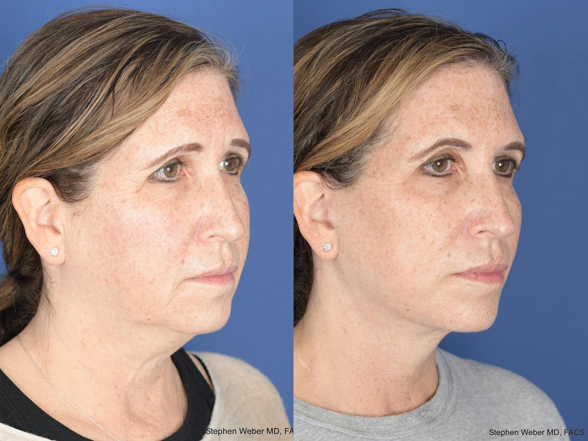 Facelift Before & After Gallery - Patient 406156 - Image 2