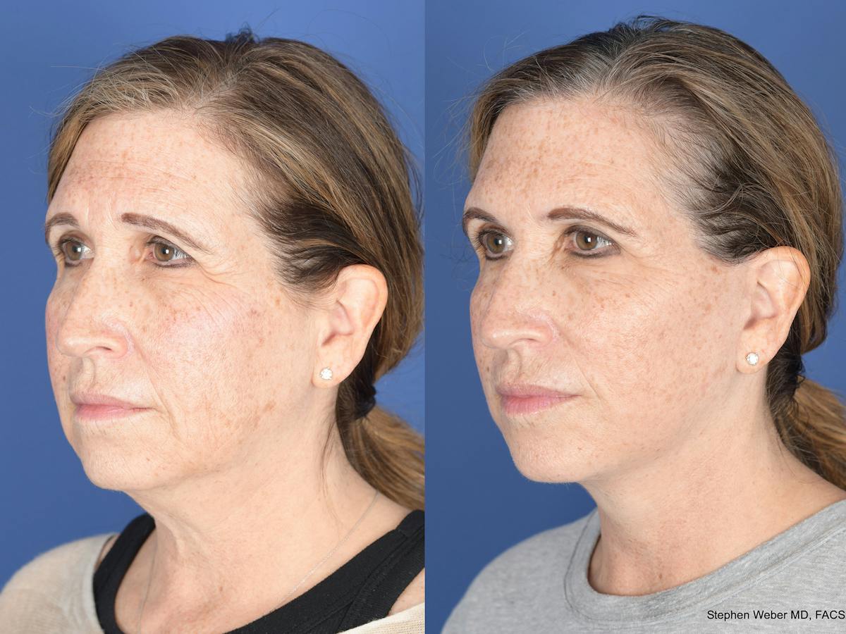 Facelift Before & After Gallery - Patient 406156 - Image 4