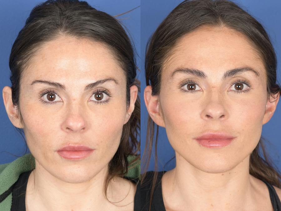Facial Fat Transfer Before and After Photos