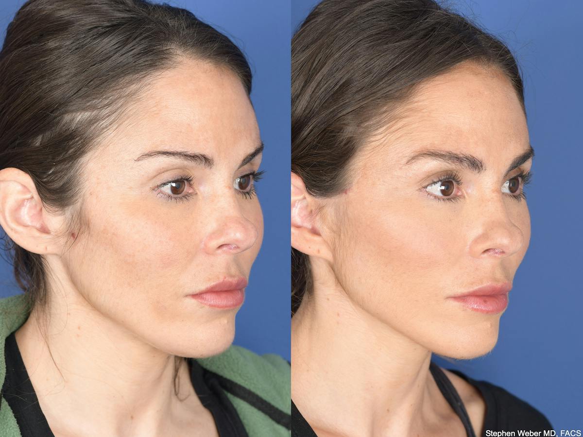 Fat Transfer Before & After Gallery - Patient 661710 - Image 2
