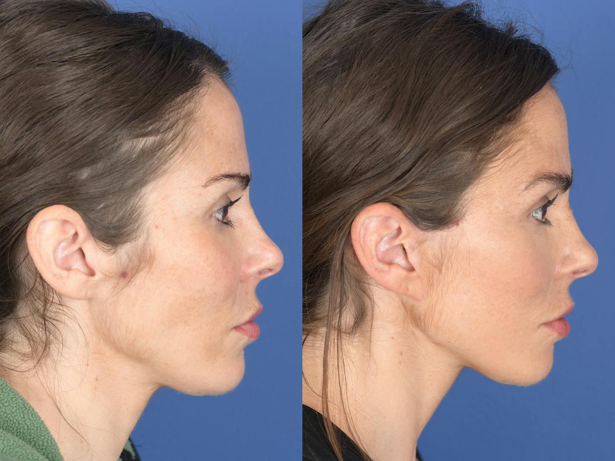 Fat Transfer Before & After Gallery - Patient 661710 - Image 3