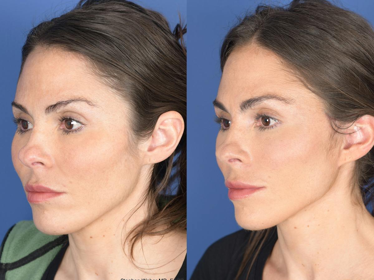 Fat Transfer Before & After Gallery - Patient 661710 - Image 4