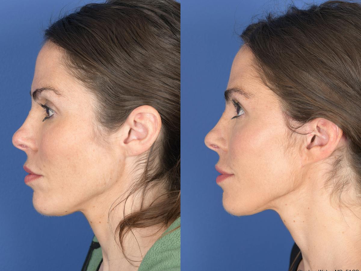 Fat Transfer Before & After Gallery - Patient 661710 - Image 5
