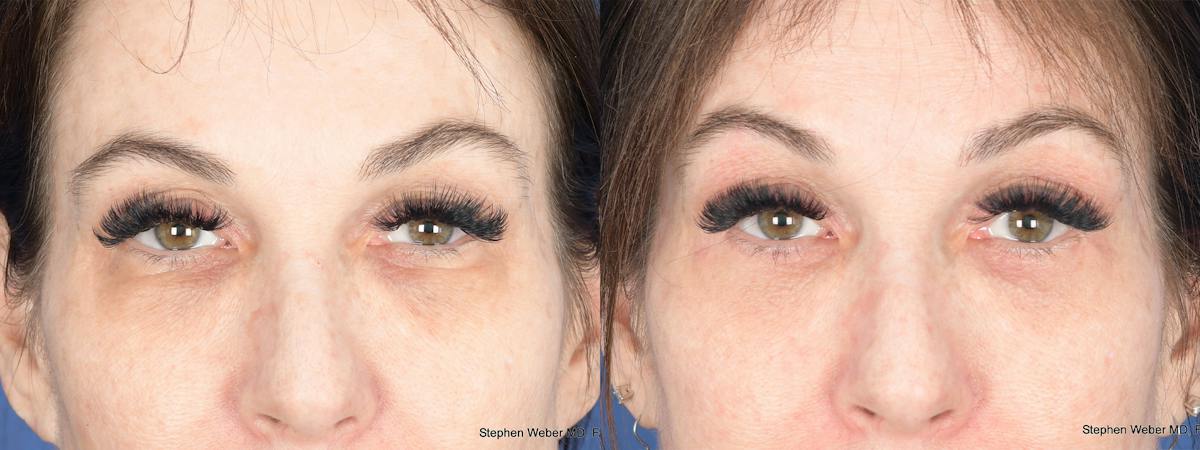 Blepharoplasty Before & After Gallery - Patient 194979 - Image 1