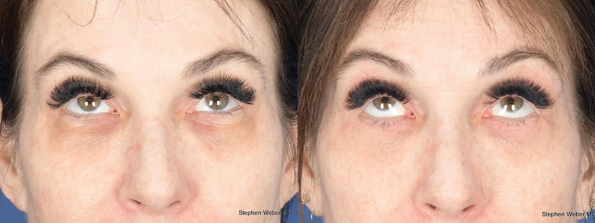 Blepharoplasty Before & After Gallery - Patient 194979 - Image 2