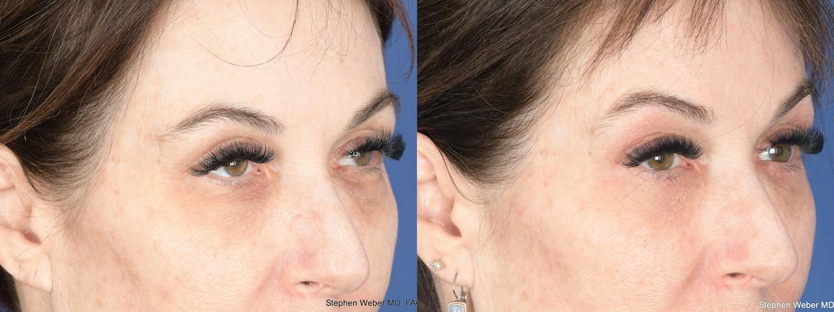 Blepharoplasty Before & After Gallery - Patient 194979 - Image 3