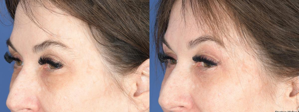 Blepharoplasty Before & After Gallery - Patient 194979 - Image 5