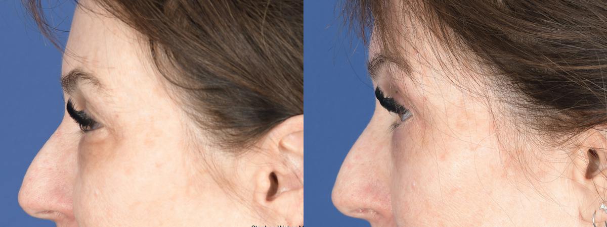 Blepharoplasty Before & After Gallery - Patient 194979 - Image 6