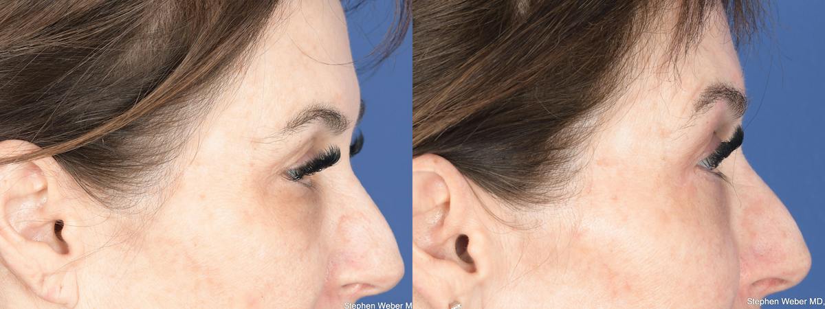 Blepharoplasty Before & After Gallery - Patient 194979 - Image 4