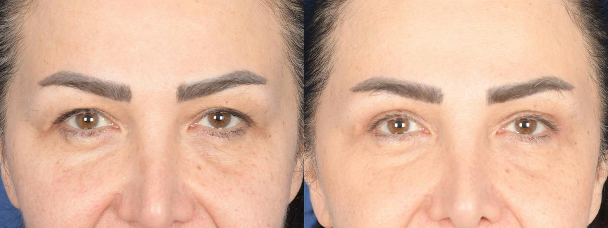 Blepharoplasty Before & After Gallery - Patient 484052 - Image 1