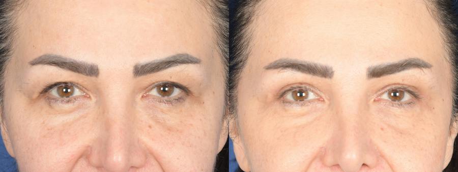 Eyelid Surgery Before and After Photos