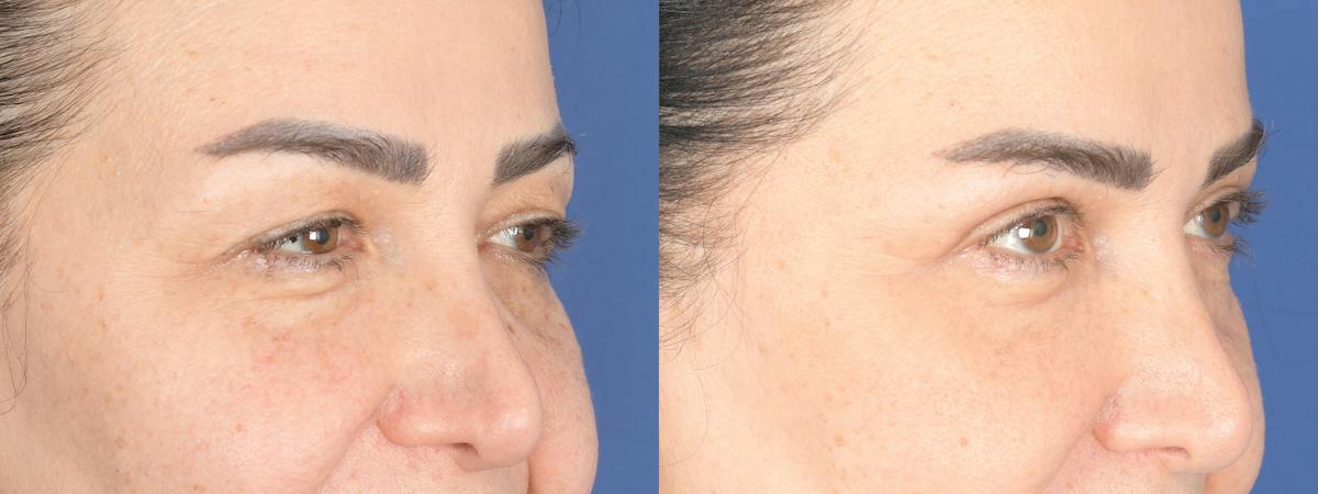 Blepharoplasty Before & After Gallery - Patient 484052 - Image 2