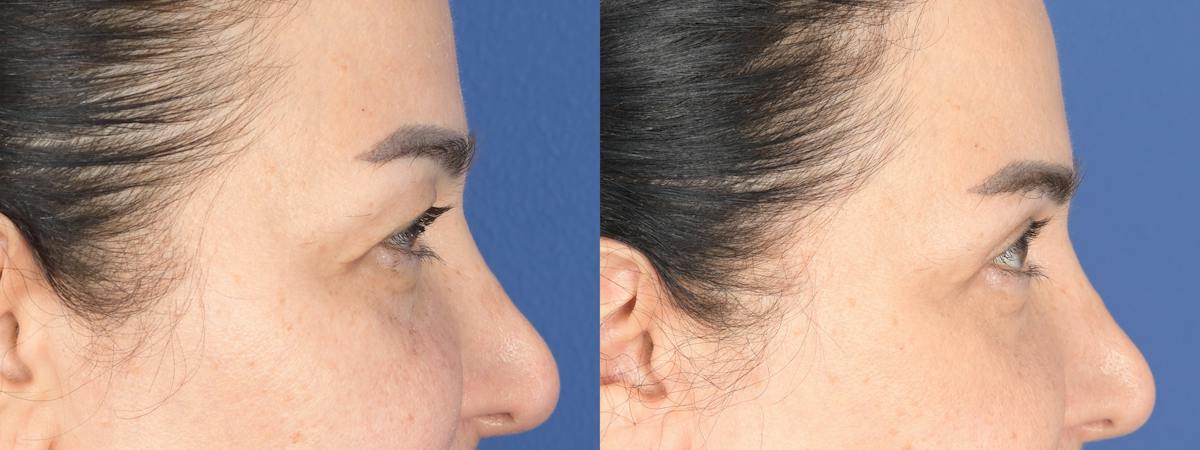 Blepharoplasty Before & After Gallery - Patient 484052 - Image 3