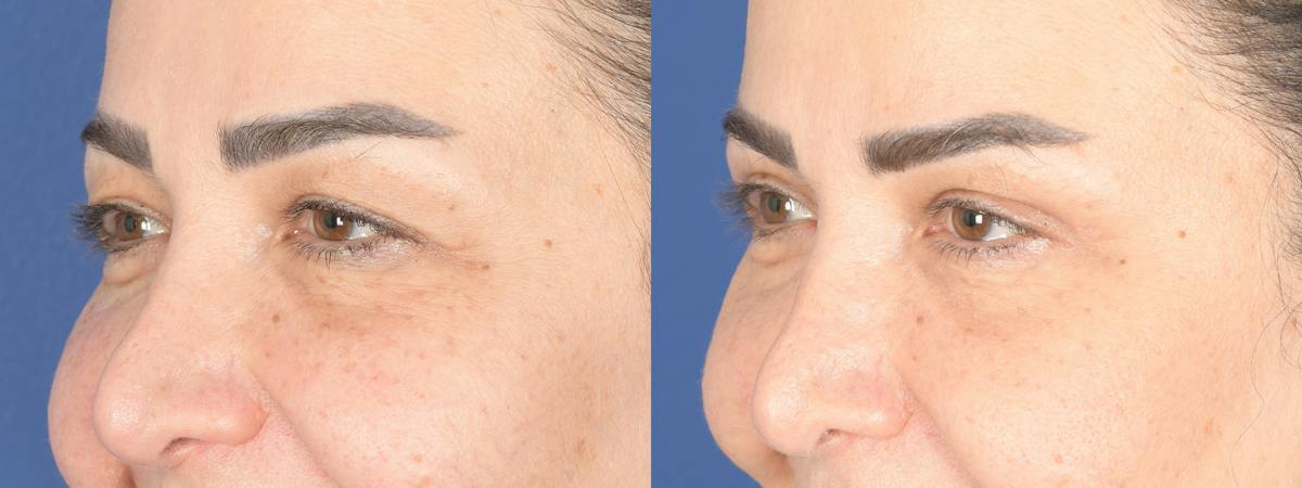 Blepharoplasty Before & After Gallery - Patient 484052 - Image 4