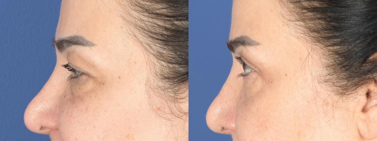 Blepharoplasty Before & After Gallery - Patient 484052 - Image 5