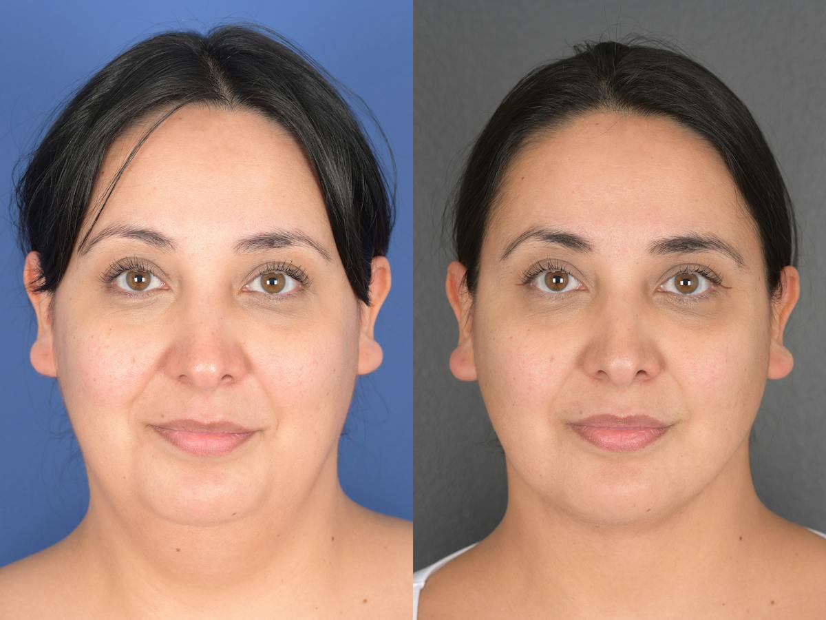 Necklift Before & After Gallery - Patient 140708 - Image 1