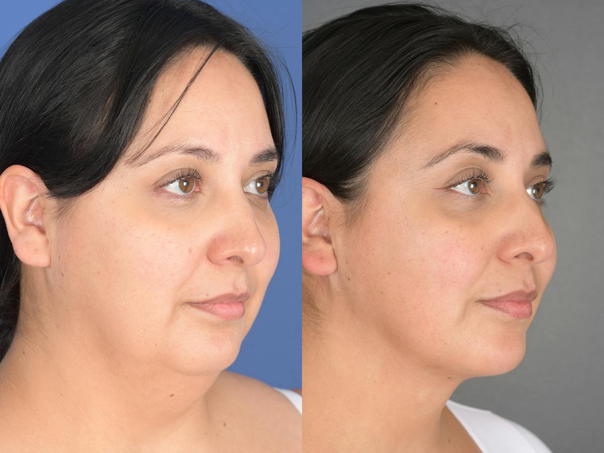 Necklift Before & After Gallery - Patient 140708 - Image 2