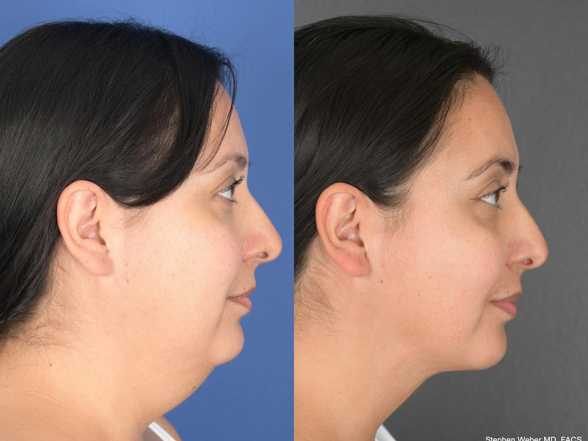 Necklift Before & After Gallery - Patient 140708 - Image 3