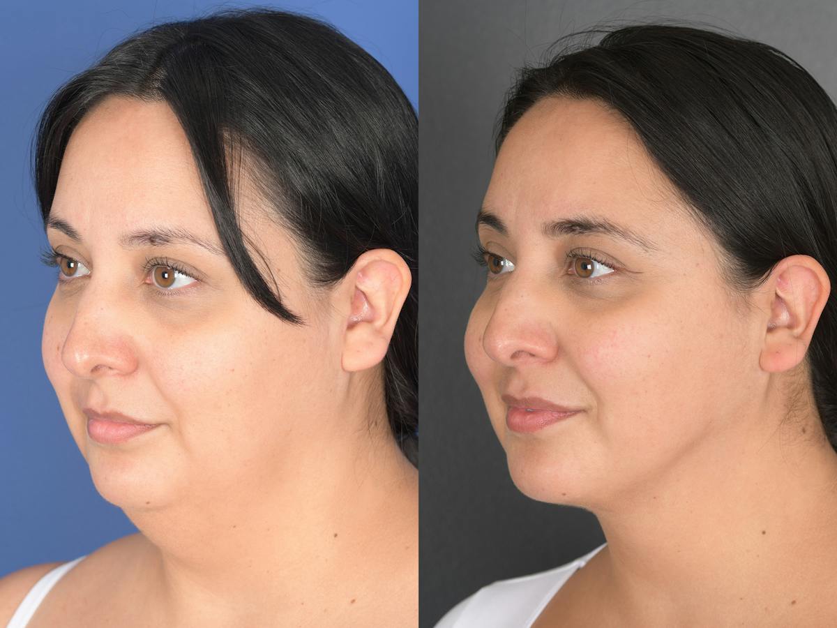 Necklift Before & After Gallery - Patient 140708 - Image 4