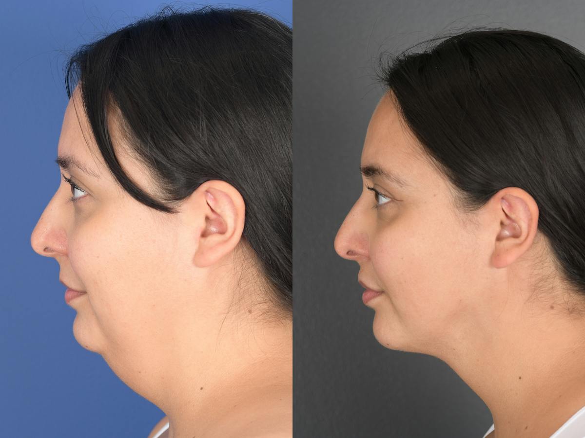 Necklift Before & After Gallery - Patient 140708 - Image 5