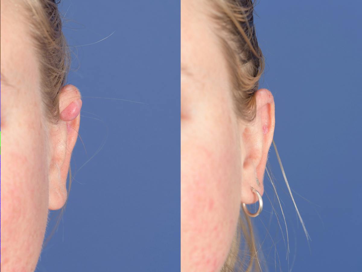 Scar Revision Before & After Gallery - Patient 316315 - Image 3
