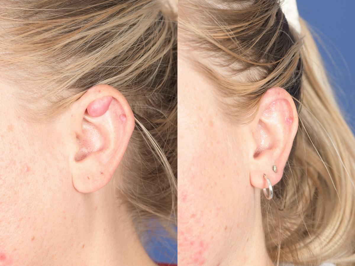 Scar Revision Before & After Gallery - Patient 316315 - Image 2
