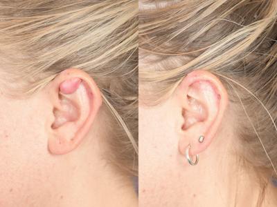 Scar Revision Before & After Gallery - Patient 316315 - Image 1