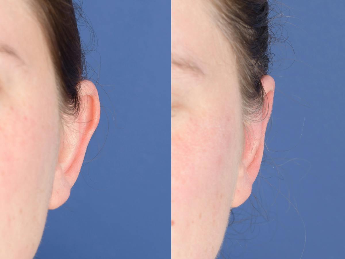Otoplasty Before & After Gallery - Patient 396908 - Image 1