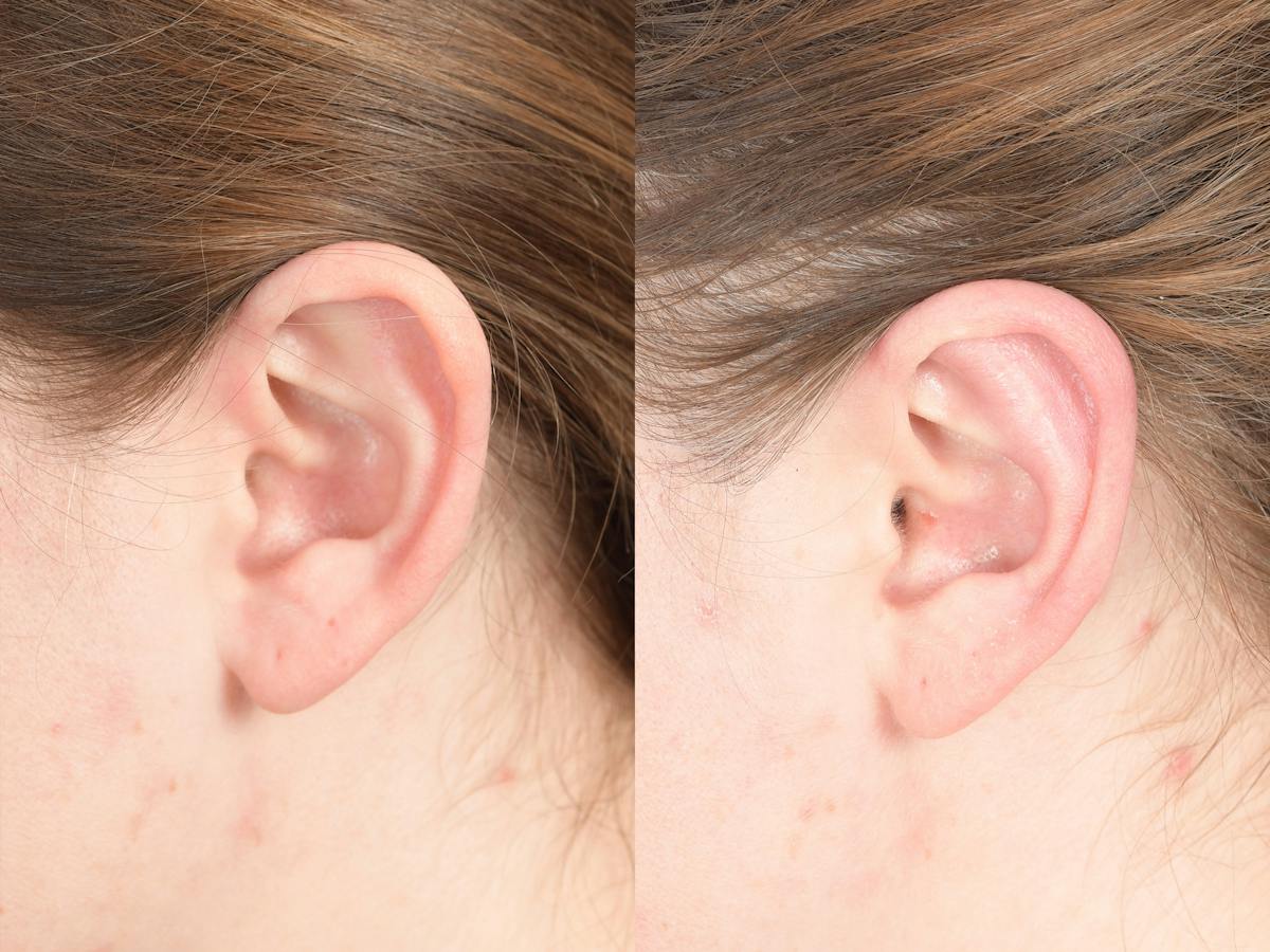 Otoplasty Before & After Gallery - Patient 396908 - Image 4